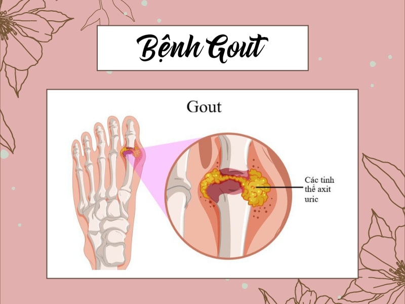 Bệnh gout là bệnh viêm khớp do sự lắng đọng của các tinh thể muối urat trong dịch khớp và các mô xung quanh