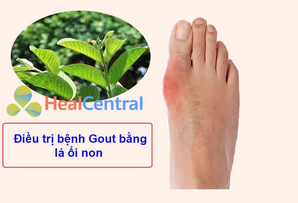 Lá ổi non – vị thuốc Nam chữa bệnh Gout hiệu quả