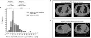 Hình 1. Hình a Phân phối tần số của 68 bệnh nhân ARDS theo mức độ huy động phổi, được biểu thị bằng tỷ lệ phần trăm của tổng trọng lượng phổi. ALI mà không có ARDS được xác định bằng PaO2/FiO2 nhỏ hơn 300 nhưng không dưới 200 và ARDS được xác định bằng PaO2/FiO2 dưới 200. Lượng phổi có thể huy động được xác định là tỷ lệ mô phổi trong đó sục khí được phục hồi ở áp lực đường thở trong khoảng từ 5 đến 45 cmH2O. Hình b Các lát cắt CT đại diện của phổi thu được 2 cm trên vòm hoành ở áp lực đường thở là 5 cmH2O (trái) và 45 cmH2O (phải) từ một bệnh nhân có tỷ lệ phổi có thể huy động thấp hơn (bằng hoặc thấp hơn giá trị trung bình là 9% tổng trọng lượng phổi). Hình c Các lát cắt CT đại diện của phổi thu được 2 cm trên vòm hoành ở áp lực đường thở là 5 cmH2O (trái) và 45 cmH2O (phải) từ một bệnh nhân trong nhóm có tỷ lệ phổi có thể huy động cao hơn (Tái tạo từ Gattinoni et al. [13])