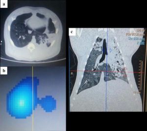 Hình 5 EIT đại diện cho một lát rất dày của phổi. Lưu ý rằng hình ảnh CT trục cắt ngang (0,5 cm): (a) không cho thấy sự suy yếu của phổi trái, trong khi EIT cho thấy thâm hụt lớn ở phổi trái; (b) Sau đó, khi nhìn vào khung nhìn vành (c), người ta có thể hiểu rằng EIT đã tiết lộ sự suy yếu lớn của phổi trái ở các khu vực phía trên mặt phẳng cắt ngang. Động vật này bị ARDS cộng với viêm phổi.