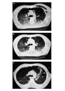 Hình 2. CT scan bệnh nhân ARDS do đa chấn thương.