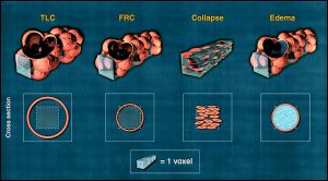 Hình 3. Mối quan hệ giữa đơn vị phổi CT và acini phế nang trong điều kiện bình thường ở dung tích cặn chức năng (FRC), ở mức hai phần ba tổng dung tích phổi (TLC), với phế nang bị xẹp, và ở loại phế nang bị phù.