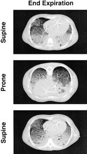 Hình 6. Hình ảnh CT của ARDS nằm ngửa (hình trên), nghiêng (hình giữa) và trở về vị trí nằm ngửa (hình dưới). Các CT được thực hiện khi thở ra và 10 cm H2O PEEP. Lưu ý cách mật độ phụ thuộc vào trọng lực chuyển từ mặt lưng sang bụng trong vòng vài phút khi bệnh nhân xoay sang nằm ngửa.