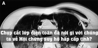 Chụp cắt lớp điện toán đã nói gì với chúng ta về Hội chứng suy hô hấp cấp tính?