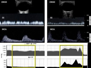Hình 2 Theo dõi áp lực nội sọ xâm lấn và không xâm lấn, thông qua ICP Bolt và qua siêu âm não (BUS, đường kính vỏ thần kinh thị giác và lấy mẫu Doppler mạch máu não) ở bệnh nhân tổn thương sọ não và ARDS.