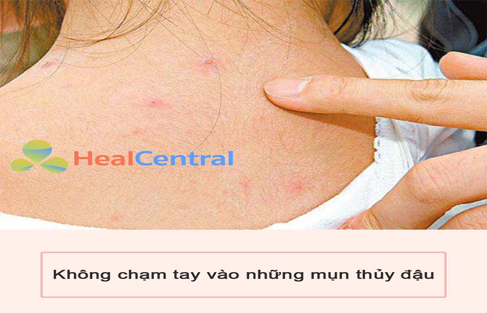 Không chạm tay vào những mụn thủy đậu 