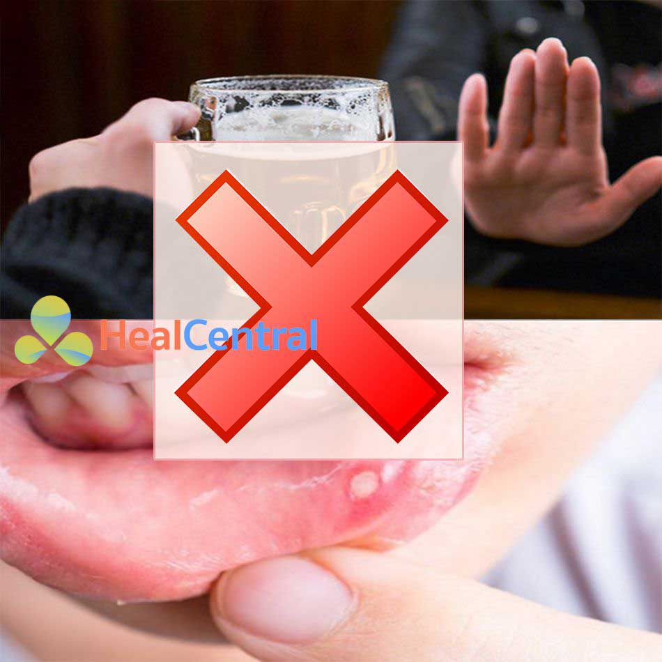 Thức uống có cồn không tốt cho người bị nhiệt miệng