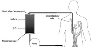 Các ứng dụng hiện tại cho việc sử dụng loại bỏ Carbon Dioxide ngoài cơ thể ở bệnh nhân bị bệnh nặng