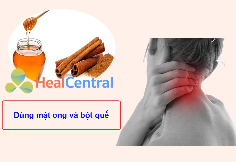 Dùng mật ong và bột quế để giảm đau nhức