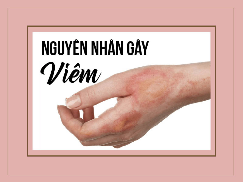 Viêm có thể do nhiều nguyên nhân gây ra