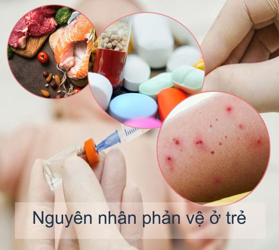 Nguyên nhân phản vệ ở trẻ em