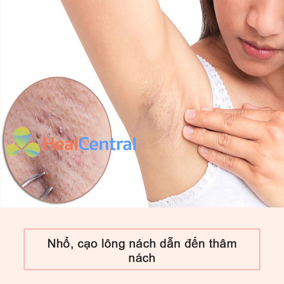 Loại bỏ lông nách bằng việc nhổ, cạo dẫn đến bị thâm nách