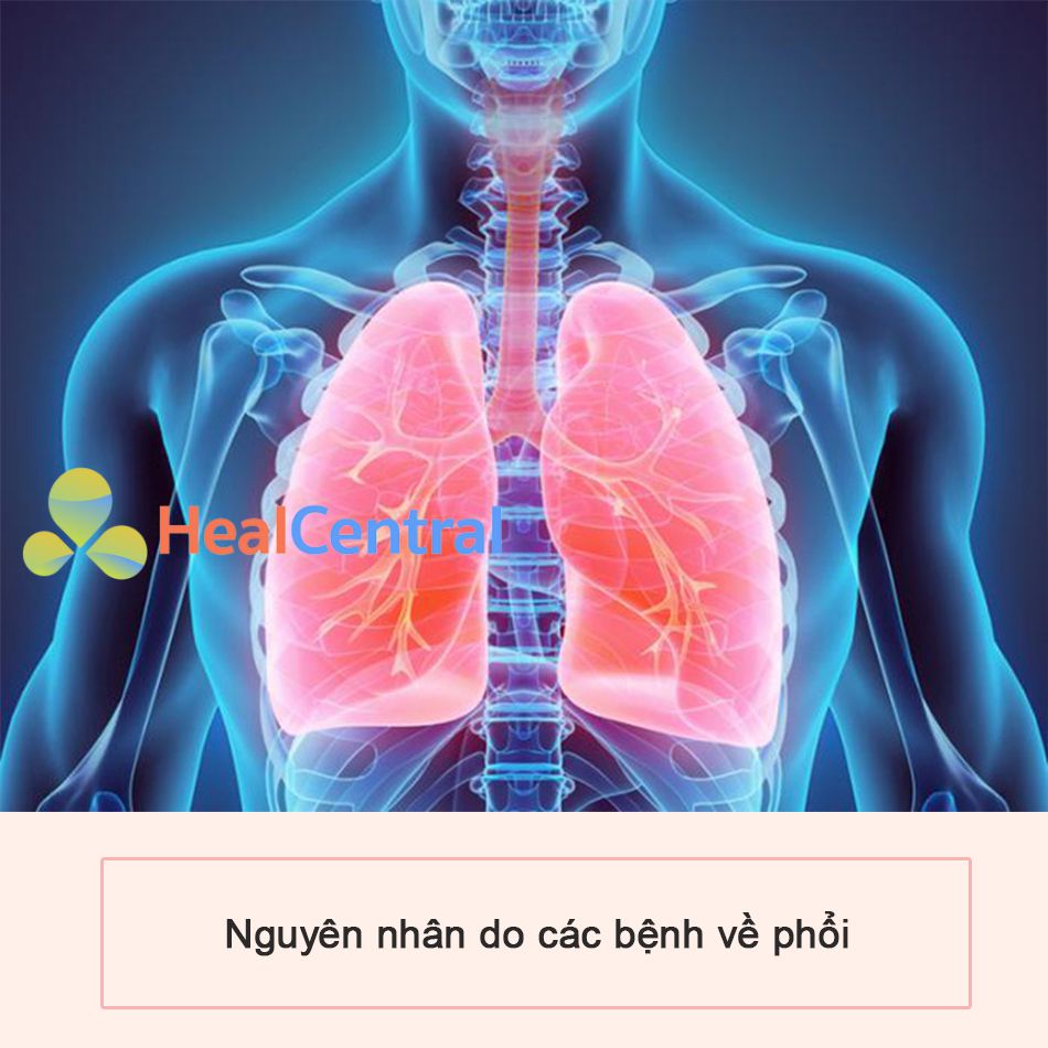Các bệnh về phổi cũng đẫn đến đau tức ngực