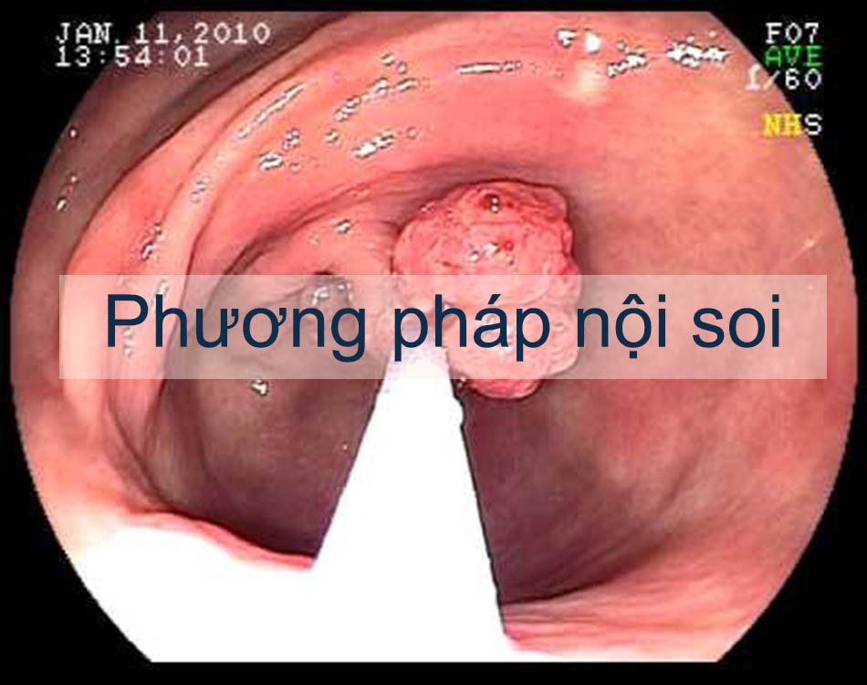 Phương pháp chuẩn đoán polyp hậu môn