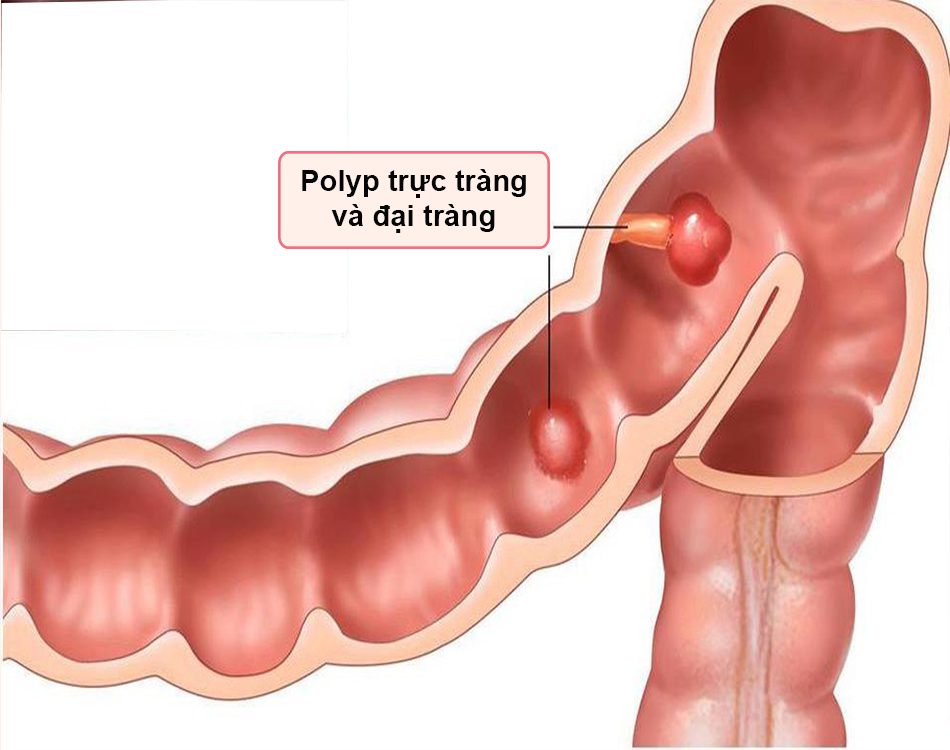 Đi ngoài ra máu do Polyp trực tràng và đại tràng