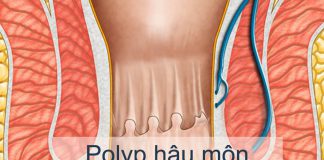 Polyp hậu môn