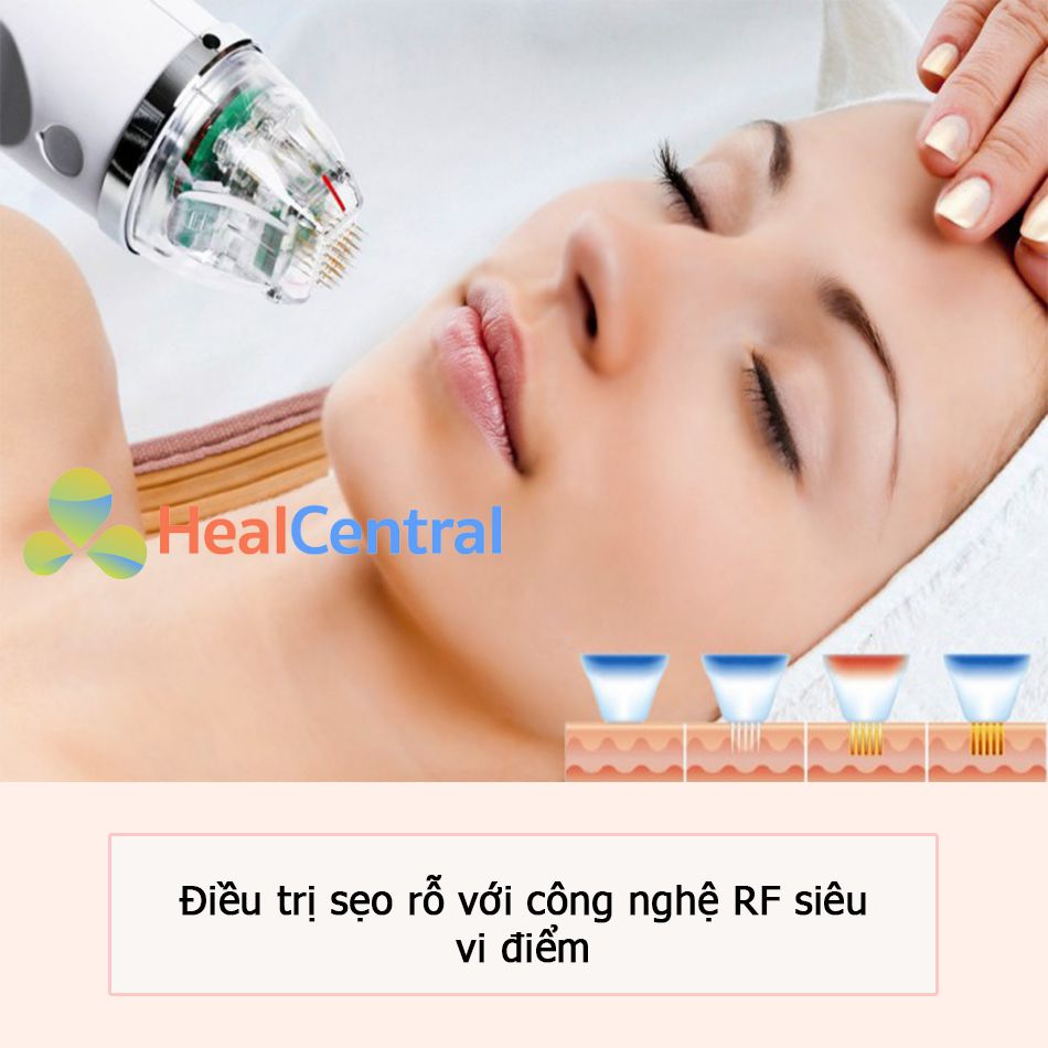 Điều trị sẹo rỗ với công nghệ RF siêu vi điểm