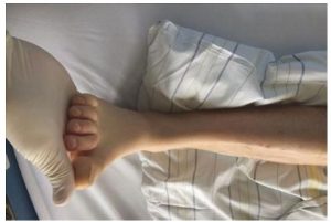 Hình 1.15 Tăng phản xạ dạn ra thoáng qua của bàn chân để kiểm tra sự hiện diện clonus. Được sự cho phép của Martin W. Dünser, MD