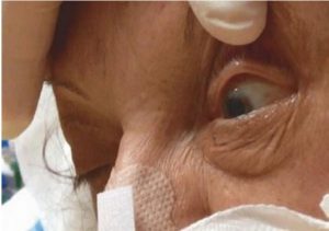 Hình 1.21 Mở mắt thụ động có thể cho thấy tình trạng giật mí mắt theo nhịp điệu tinh tế ở bệnh nhân động kinh không co giật. Được sự cho phép của Martin W. Dünser, MD