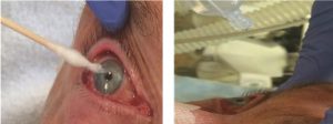 Hình 1.7 Kiểm tra phản xạ giác mạc bằng khăn bông (a) hoặc bằng cách nhỏ natri clorua vô trùng vào mắt (b) Được phép của Martin W. Dünser, MD