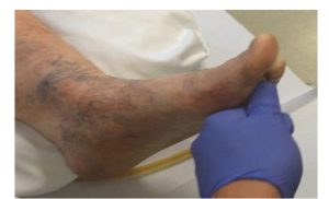 Hình 1.12 Phản ứng gan bàn chân hoặc dấu hiệu Babinski bên trái (“ngón chân cái hếch lên”) ở bệnh nhân đột quỵ bên phải. Được sự cho phép của Martin W. Dünser, MD