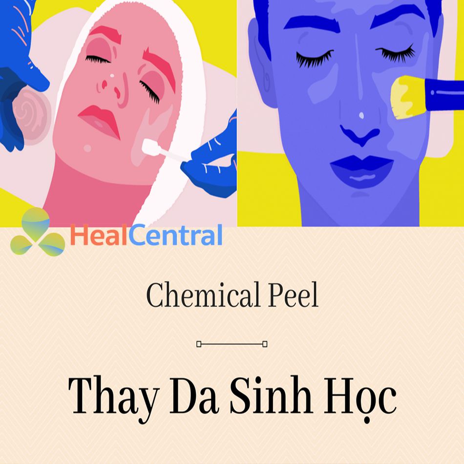 Trị sẹo lõm với phương pháp Chemical peeling