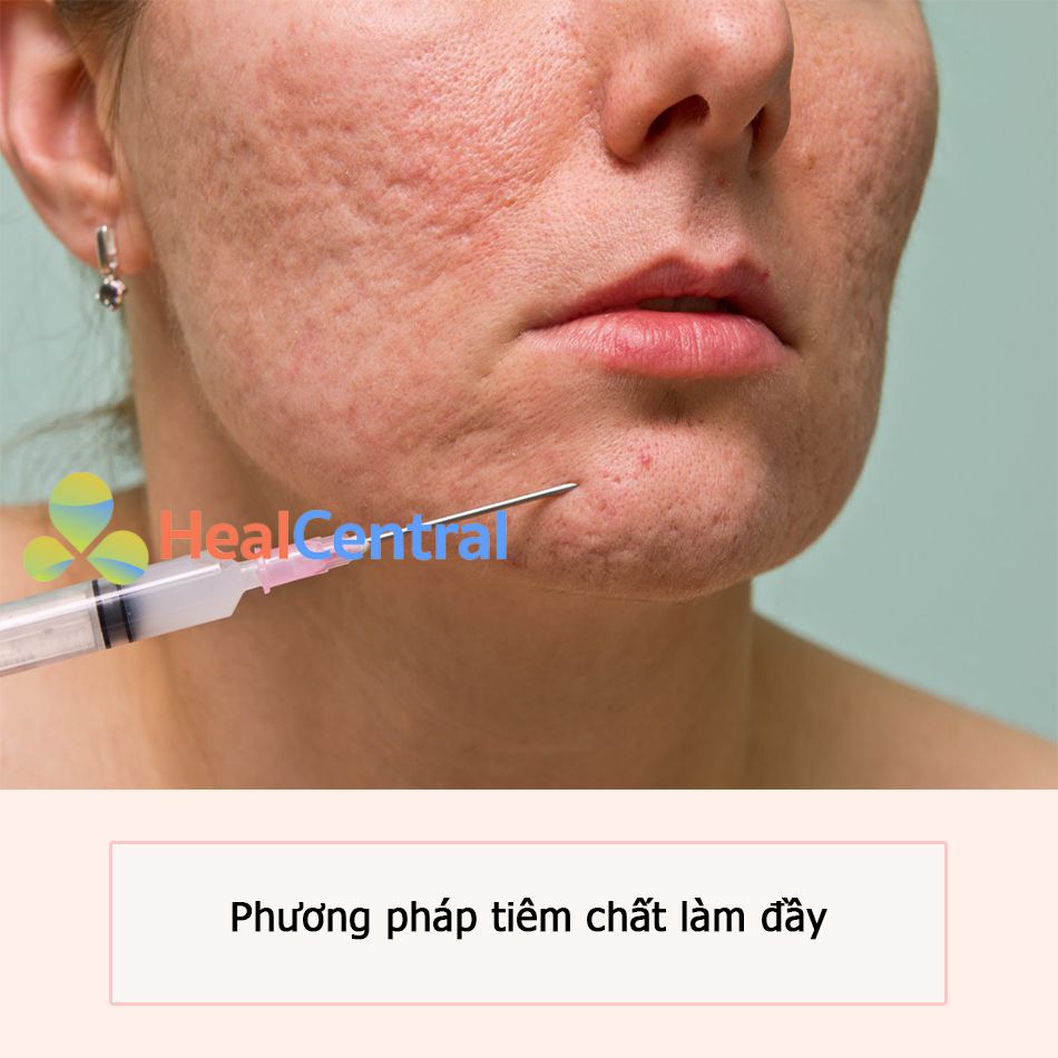 Trị sẹo lõm bằng phương pháp tiêm chất làm đầy