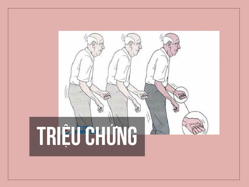 Triệu chứng lâm sàng của bệnh Parkinson