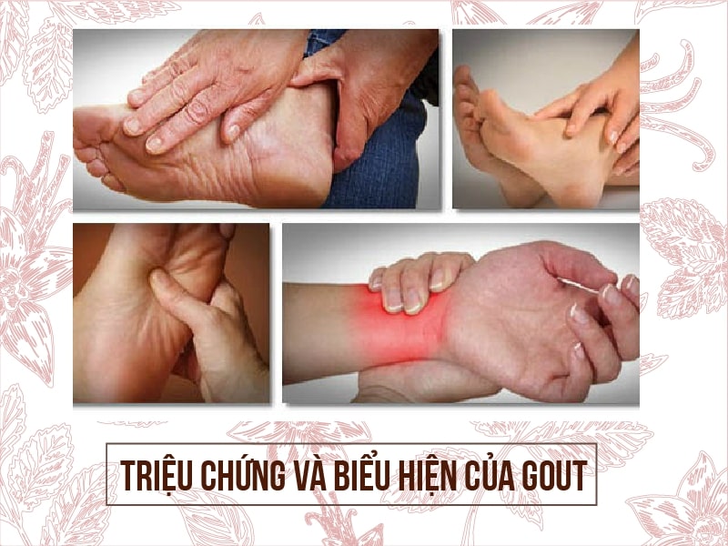 Một số triệu chứng và biểu hiện của Gout