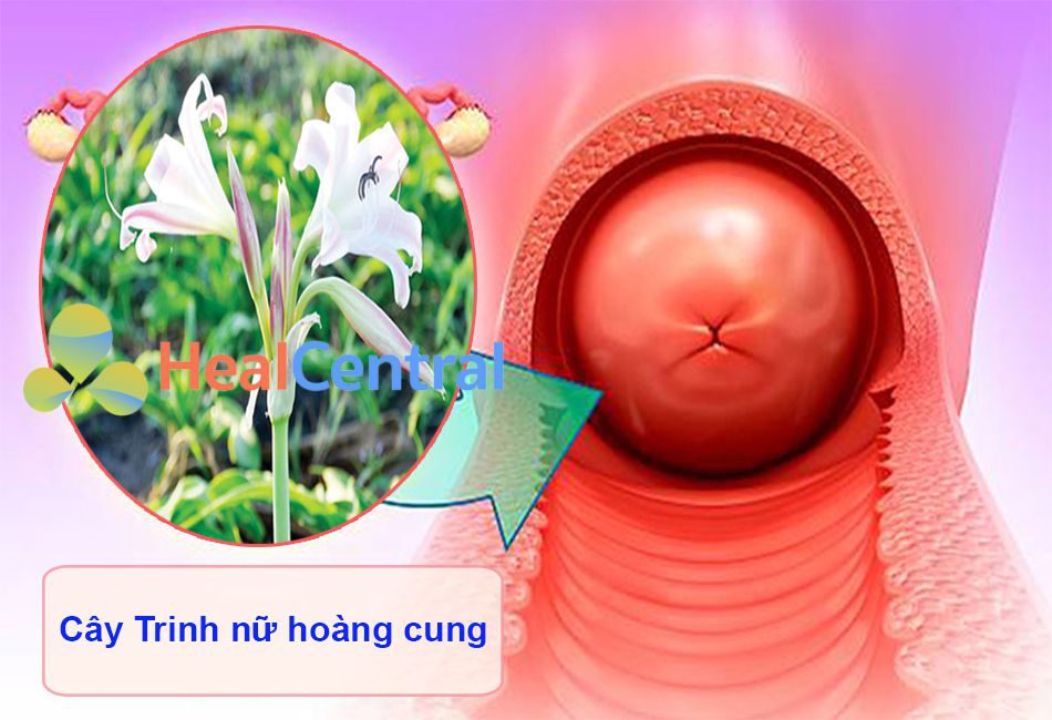 Điều trị viêm lộ tuyến cổ tử cung bằng cây Trinh nữ hoàng cung