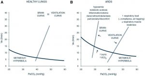 Hình 1. Đường hyperbol chuyển hóa, đường cong não và thông khí khi khỏe mạnh và ARDS.