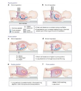 Hình 1 Phân phối các vùng phổi được sục khí, kém sục khí và không sục khí cuối thì thở ra (a và c) và cuối thì hít vào (b và d) ở tư thế nằm ngửa và ở tư thế nằm sấp. Các lò xo là độ đàn hồi thể hiện cho phổi và thành ngực. Các hình (e và f) hiển thị phân phối tưới máu phổi ở tư thế nằm ngửa và ở tư thế nằm sấp.