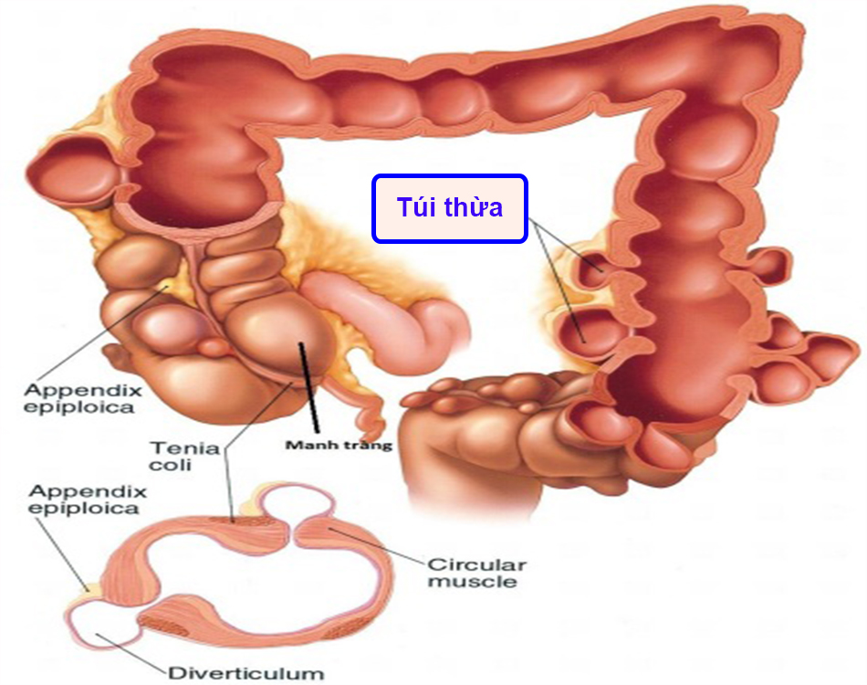 Viêm túi thừa gây đi ngoài ra máu