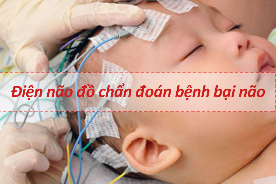 Điện não đồ chẩn đoán bệnh bại não