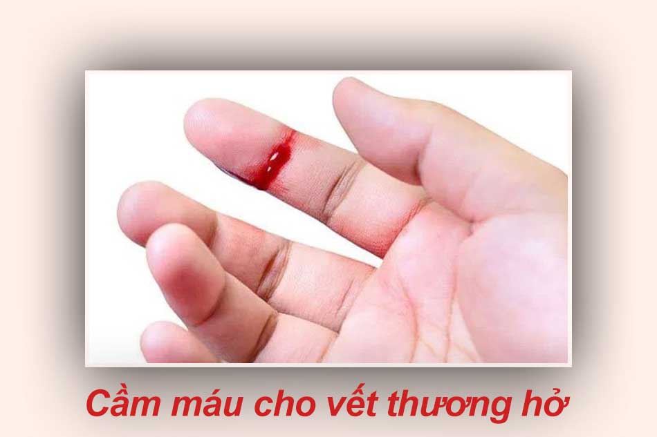 Cầm máu cho vết thương hở