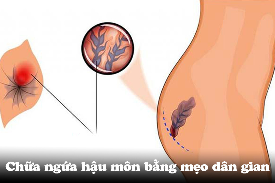 Chữa ngứa hậu môn bằng mẹo dân gian