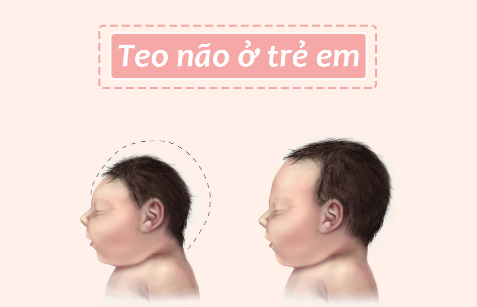 Bệnh teo não ở trẻ em