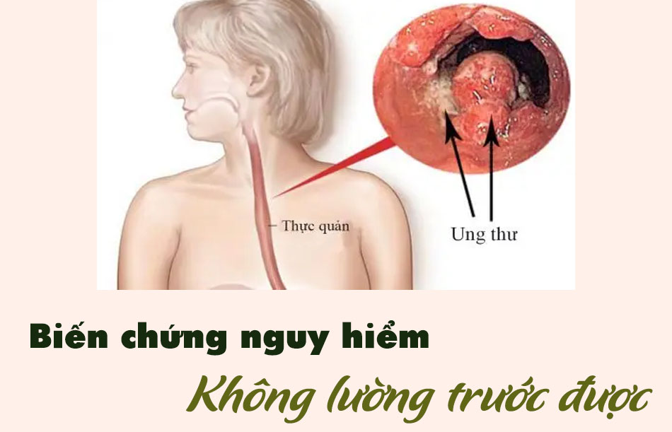 Biến chứng ở viêm họng hạt ở lưỡi