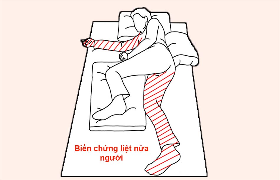 Biến chứng liệt nửa người