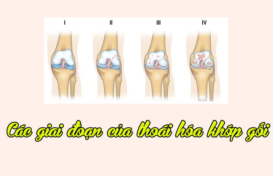 Các giai đoạn của thoái hóa khớp