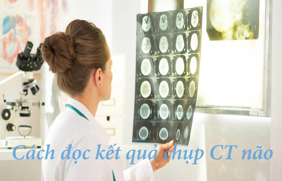 Cách đọc kết quả chụp CT não