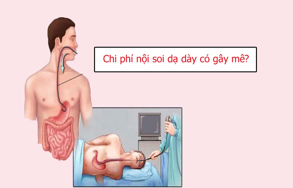 Chi phí phương pháp nội soi dạ dày có gây mê?