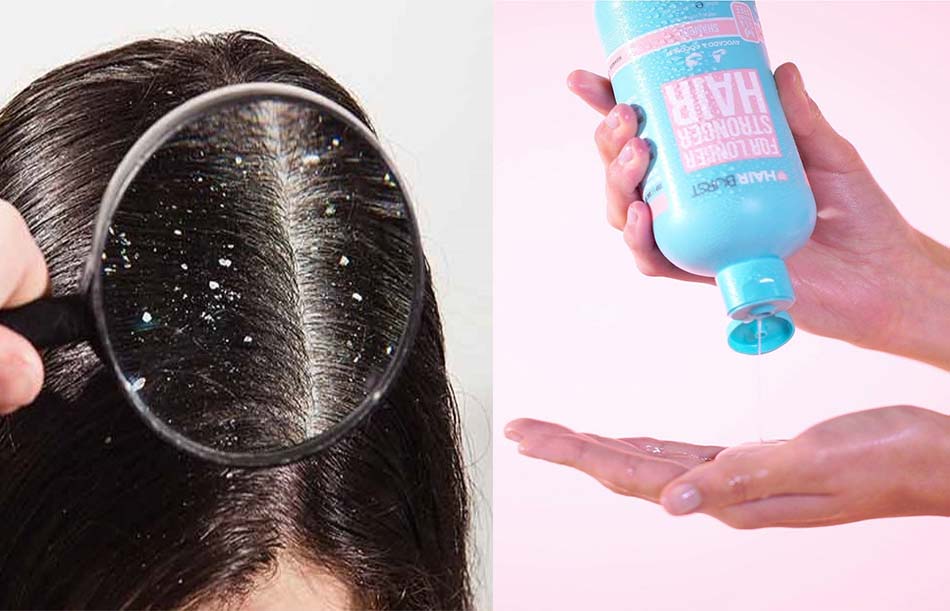 Dầu gội Hairburst có chống gàu không?