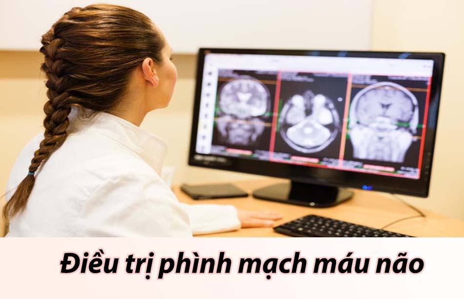 Điều trị phình mạch máu não