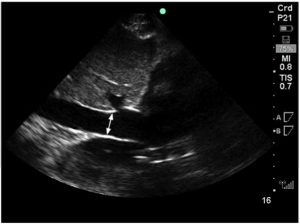 Hình 1. Một khung nhìn dưới sườn của IVC đi vào tâm nhĩ phải. Đường kính IVC đo được khoảng 2 cm so với điểm nối của IVC với tâm nhĩ phải.