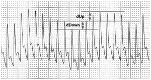 Hình 4. Một dạng sóng động mạch cho thấy sự thay đổi theo hô hấp của dạng sóng động mạch và sự khác biệt giữa áp lực tâm thu tối thiểu và tối đa trong chu kỳ hô hấp. Một đường cơ bản được thiết lập trong quá trình thở ra và các thành phần dUp và dDown được đo bằng khoảng cách từ đường cơ bản này.