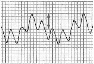 Hình 5. Một phép đo pulse oximetry cho thấy sự khác biệt giữa các đỉnh cực đại và cực tiểu ở một bệnh nhân có khả năng đáp ứng dịch