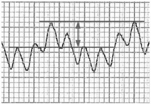 Hình 5. Một phép đo pulse oximetry cho thấy sự khác biệt giữa các đỉnh cực đại và cực tiểu ở một bệnh nhân có khả năng đáp ứng dịch