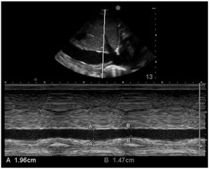 Hình 6. Một hình ảnh chế độ M của cửa số vùng dưới sườn của IVC cho thấy sự thay đổi theo hô hấp trong đường kính của nó. Nó được đo tại “điểm A” trong đó IVC bị cản trở bởi áp lực dương truyền từ thở máy trong khi hít vào và so sánh với “điểm B”, nơi IVC thư giãn khi ngưng tác động của áp lực dương ở thì thở ra.