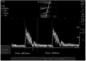 Hình 7. Một hình ảnh Doppler sóng xung của động mạch cảnh trong trục dài cho thấy dạng sóng và các phép đo biểu thị thời gian tâm thu và thời gian chu kỳ được sử dụng để tính thời gian của động mạch cảnh.